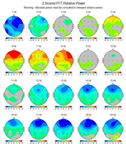 Topografske mape mozga dobivene qEEG analizom